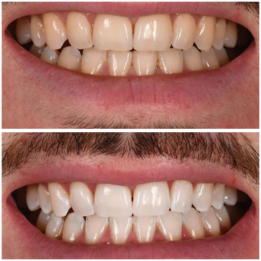 Blanchiment dentaire à domicile vs chez le dentiste : que choisir ?